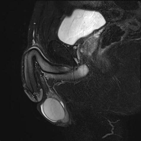 mri セックス|MRT